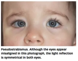 Squint vs Pseudosquint - Eyescreen™