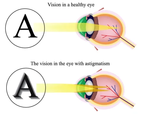 What is Astigmatism?