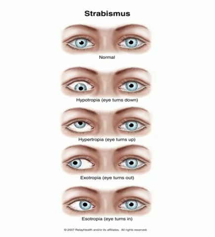 What Causes Strabismus or Crossed Eyes?