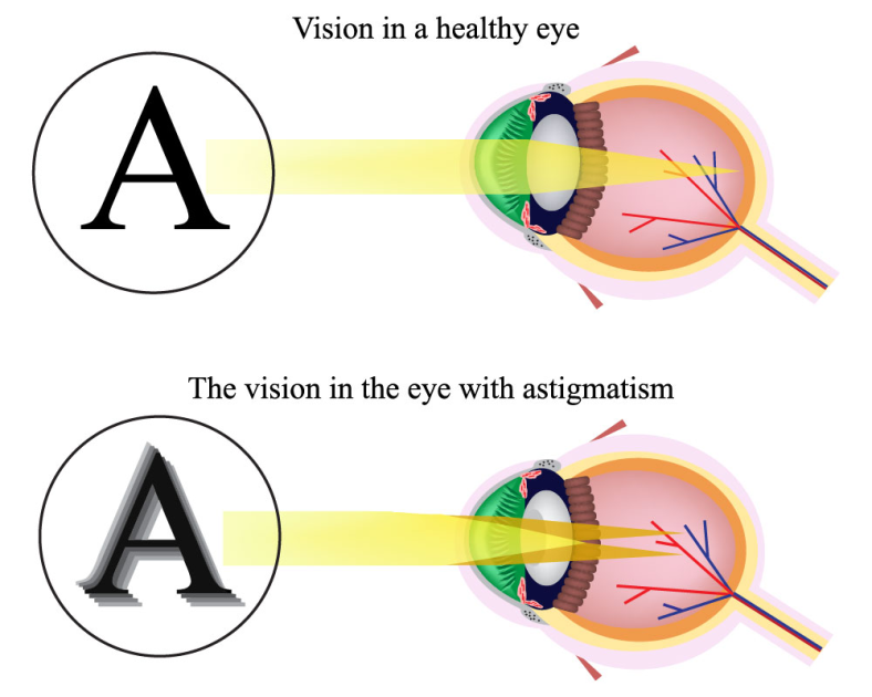 What Is Astigmatism Eyescreen™