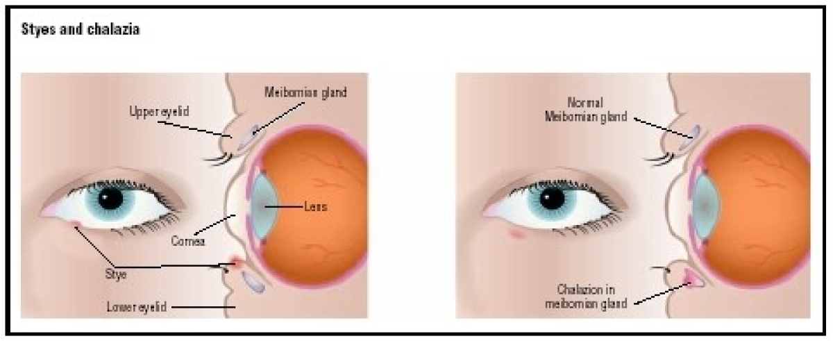 Recurring eye deals stye